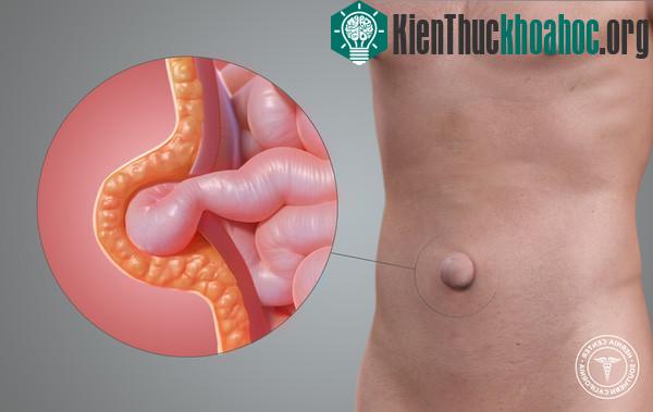 Triệu chứng sa ruột qua rốn, thường gặp ở trẻ dưới 6 tháng tuổi, khi cơ bụng tại lỗ rốn vẫn còn rất yếu.