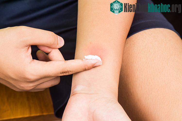Đừng gãi vết muỗi cắn