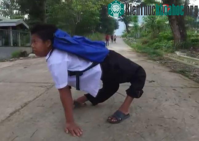 Chứng bệnh này có thể xương hông và chân phát triển không bình thường.