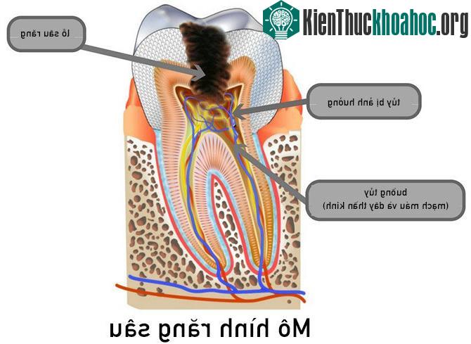 Mô hình răng sâu