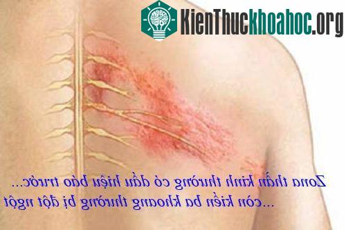Vết thương do kiến ba khoang gây ra thường xuất hiện đột ngột