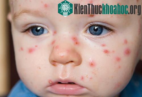 Bệnh thủy đậu và tay chân miệng có biểu hiện bóng nước khá giống nhau