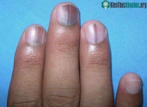 Bạn có một vết sọc đen dưới móng tay của mình