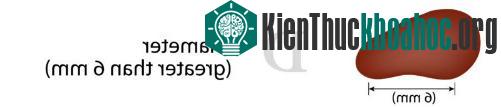 Nốt ruồi có đường kính lớn.