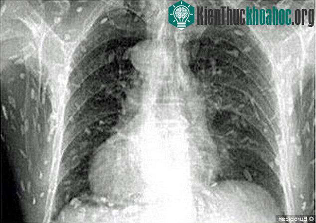 Để đề phòng nhiễm giun sán, cách tốt nhất là bạn nên ăn chín uống sôi.