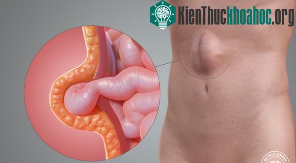 Chứng thoát vị qua vết mổ.