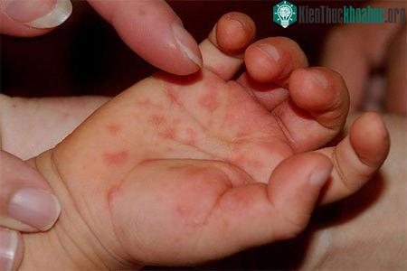 Biến chứng nặng nhất nhưng hiếm gặp nhất của bệnh tay chân miệng là viêm não