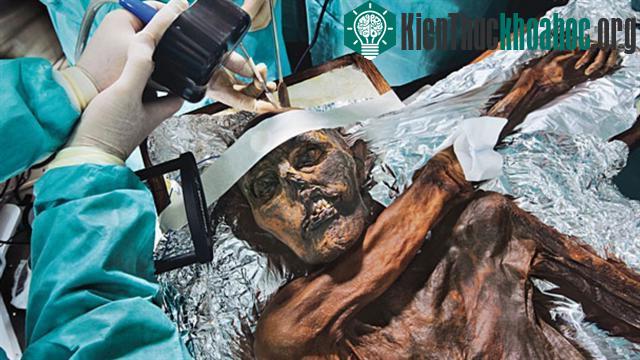 Nghiên cứu Otzi giúp y học hiểu thêm cách chữa bệnh của người cổ đại.
