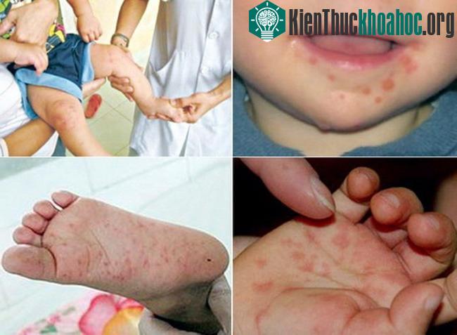 Vệ sinh cá nhân sạch sẽ giúp phòng bệnh tay chân miệng.