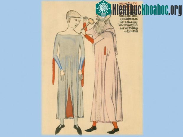 Tranh minh họa đục xương sọ. (Ảnh: Everett Historical).