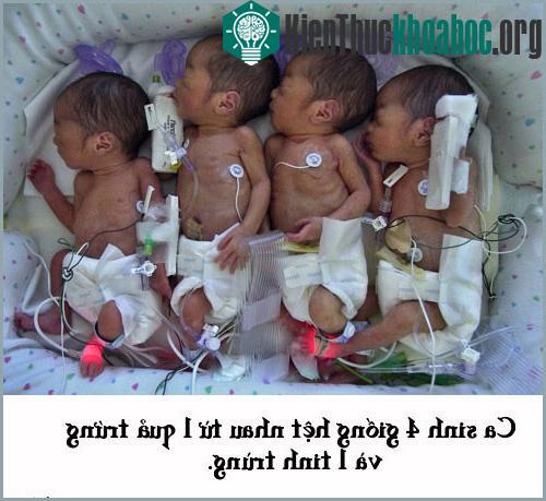 Ca sinh 4 cùng trứng giống hệt nhau