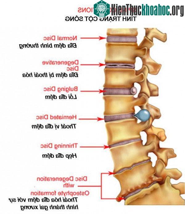Vị trí và tên gọi các triệu chứng của thoái hóa cột sống