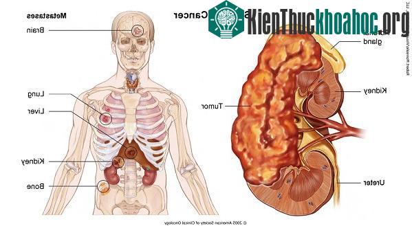 Ung thư di căn thường là giai đoạn IV của bệnh.