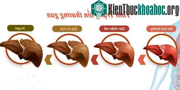 Lạm dụng kháng sinh dễ gây tổn thương gan.