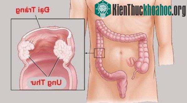 Người bệnh mắc ung thư đại, trực tràng khi các tế bào dị thường phát triển ở niêm mạc của ruột già (đại tràng) hoặc đoạn ruột thẳng cuối của ống tiêu hóa (trực tràng).