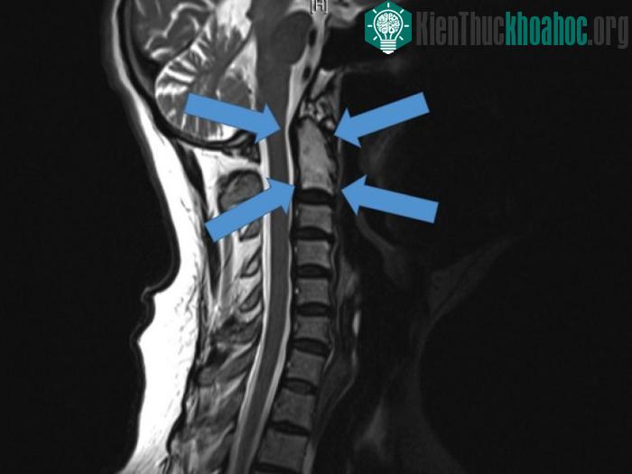 Vị trí hiểm nghèo của khối u.