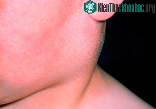 Bệnh quai bị gây viêm tuyến mang tai.