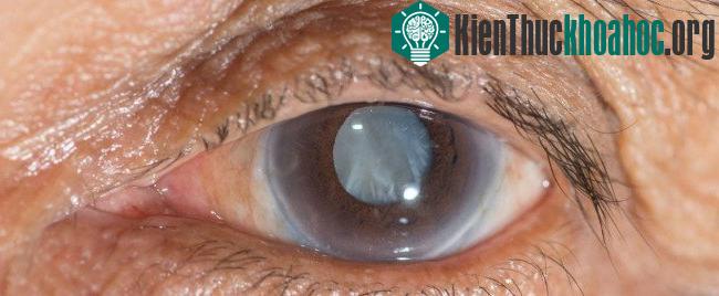 Đục thủy tinh thể ảnh hưởng đến hàng chục triệu người trên thế giới.