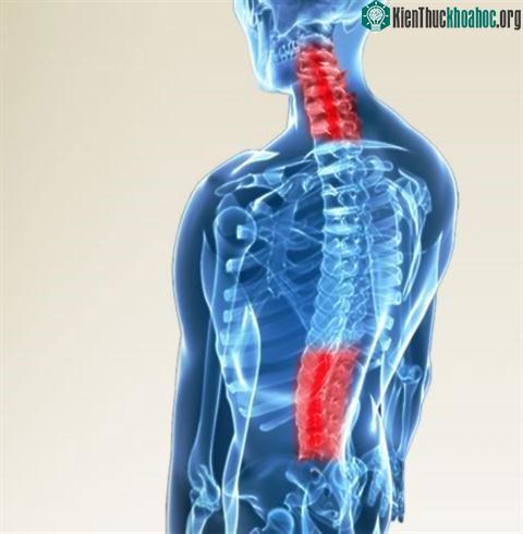 Thoái hóa cột sống