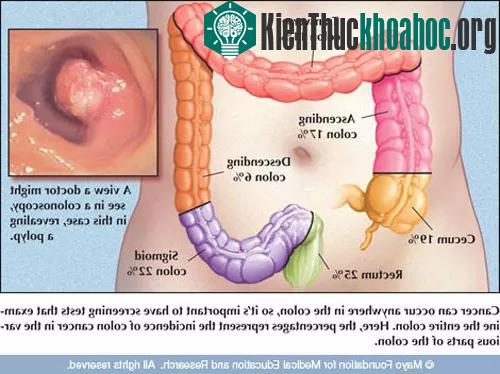 Hình ảnh polyp trong đại tràng, đây là một nguy cơ gây ung thư.