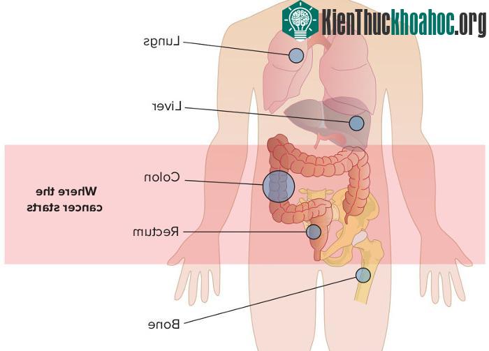 Xương, phổi, não, gan là những bộ phận thường xuyên bị di căn nhất.
