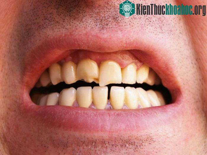 Các loại thực phẩm có tính axit cũng có thể gây hại cho răng. (Ảnh: Boldsky).