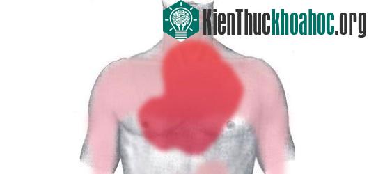 Sơ cứu nạn nhân bị đau tim