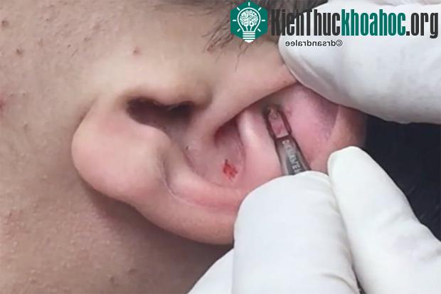 Tai là mô hình thu nhỏ của cơ thể người, nhưng chủ yếu đại diện cho thận