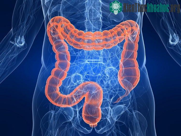 Hội chứng Lynch gây ra nhiều nhất các trường hợp ung thư đại tràng.