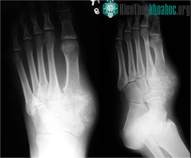 Sụn trung mô thường xảy ra ở xương sống, xương sườn và hàm.