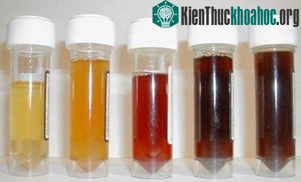 Thông qua màu sắc của nước tiểu có thể biết được điều gì đang xảy ra trong cơ thể bạn