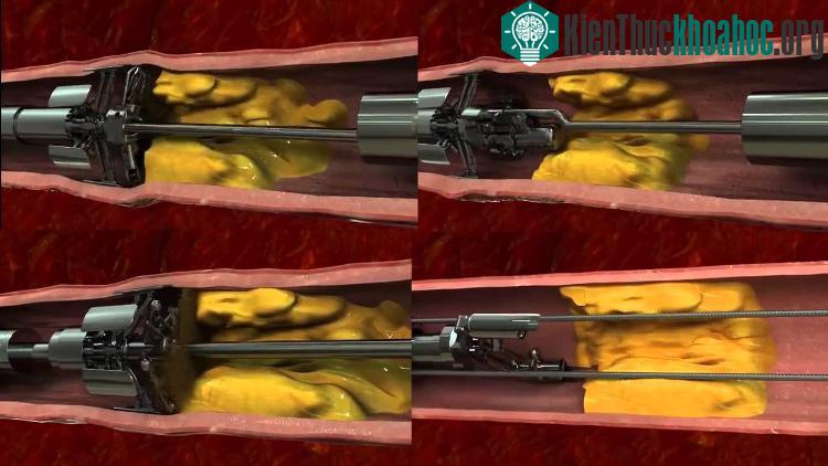 Cỗ máy "nạo vét" cholesterol ngay bên trong mạch máu.