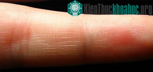 Sơ cứu vết bỏng
