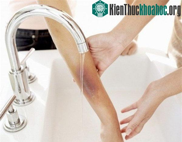 Xử lý vết thương bị bỏng