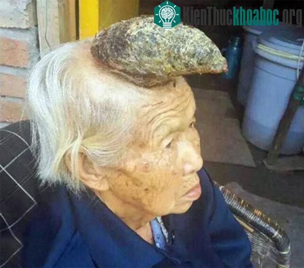 Cụ bà&nbsp;Liang Xiuzhen với cái sừng trên đầu