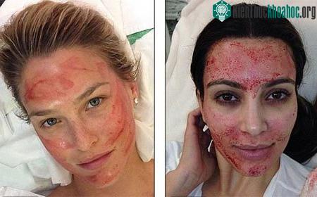 Ngôi sao truyền hình thực tế Mỹ Kim Kardashian và siêu mẫu Bar Refaeli đã giúp phương pháp&nbsp;"làm mặt kiểu ma cà rồng"&nbsp;trở nên thịnh hành. (Ảnh: Daily Mail)