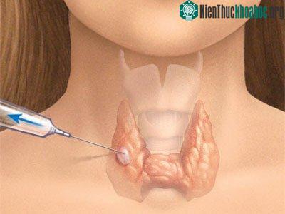 Ảnh minh họa&nbsp;chọc hút tế bào bằng kim nhỏ