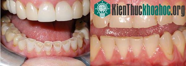 Hiện tượng bí ẩn nghiến răng khi ngủ có thể gây nên nhiều vấn đề về răng miệng