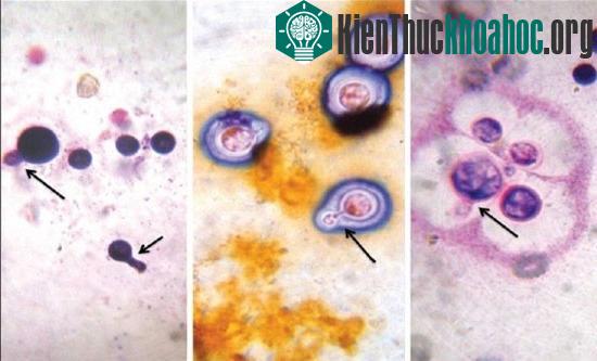 Các căn bệnh "triệu người mắc một" giống Wanbi Tuấn Anh trên thế giới