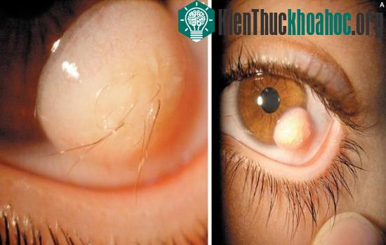 U bì kết giác mạc có thể gây mọc lông trong mắt.&nbsp;