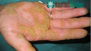 Bệnh đốm da PPK khiến da có những đốm dày, sần, gây đau đớn và bất tiện cho bệnh nhân. (Ảnh: