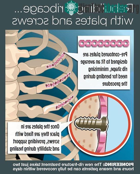 Synthes Rib Matrix – phương pháp phẫu thuật mới giúp xương gãy mau hồi phục