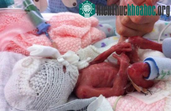 Mới chào đời, bé chỉ nặng 382g, thay vì 450g như các sĩ tưởng lúc đầu.&nbsp;