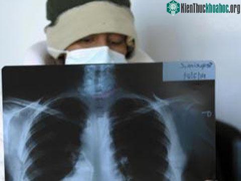 Số lượng bệnh nhân nhiễm cúm A/H1N1 năm 2009 cao hơn mức bình thường sáu lần, vì nhiều người chưa có kháng thể chống lại virus.