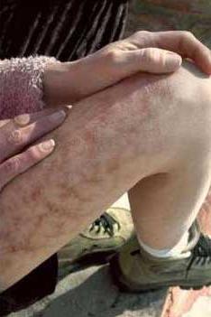 Một bệnh nhân bị hành hạ bởi căn bệnh Morgellons