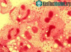 Vi khuẩn não mô cầu - Neisseria meningitidis