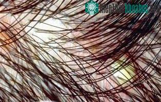 Vết mẩn ngứa trên da đầu