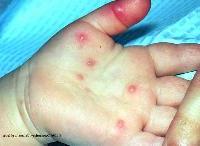 Tổn thương trong hội chứng tay, chân, miệng do enterovirus 71