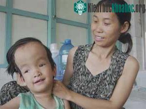 Bệnh nhi Ôn Vĩnh Hằng (7 tuổi, TP.HCM) mới được phẫu thuật đặt ống dẫn lưu dịch não tủy xuống bụng ngày 29-5 tại BV Nhi Đồng