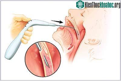 Kỹ thuật mới Pillar Procedure